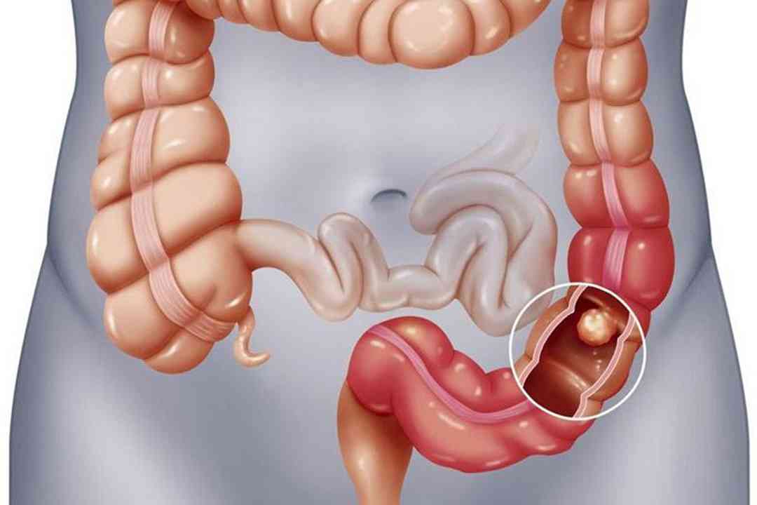 Polyp đại tràng là gì?