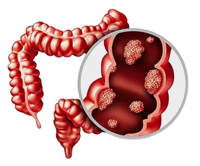 Biểu hiện của polyp đại tràng