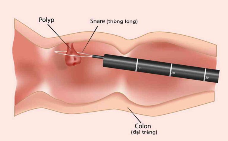 Biện pháp chẩn đoán và điều trị polyp đại tràng