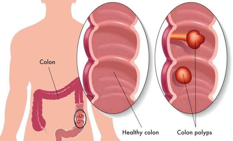 Sau khi cắt polyp đại tràng nên ăn gì?