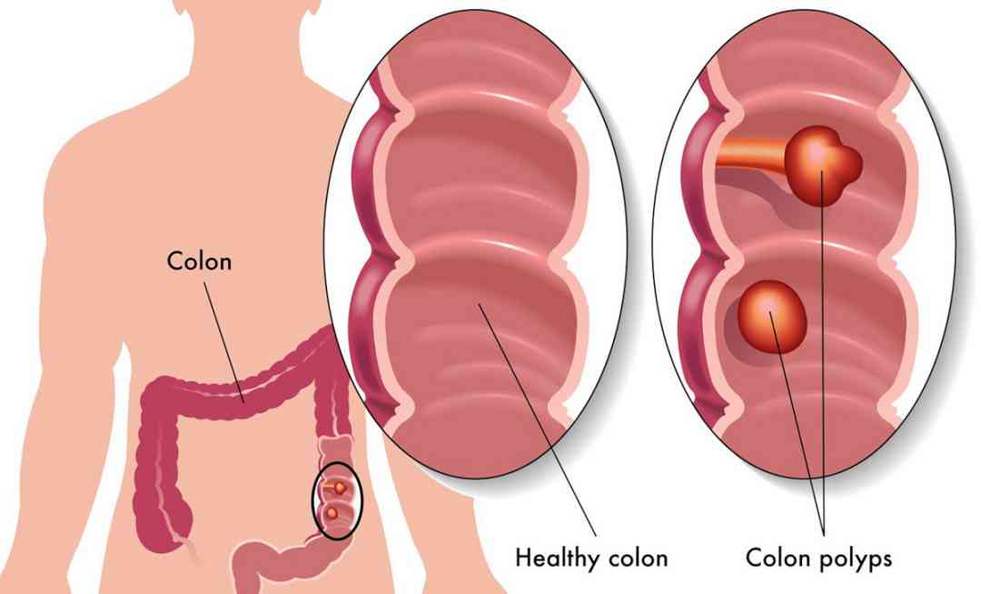 Các triệu chứng của polyp đại tràng là gì?