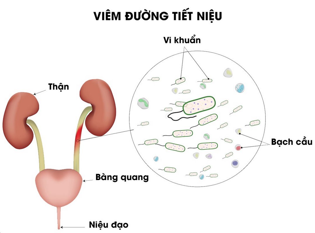 Điều trị nhiễm trùng đường tiểu thông qua kháng sinh đường uống