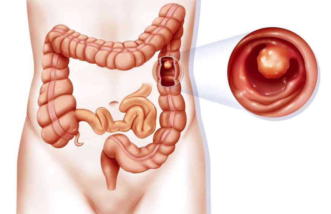 Điều trị polyp đại tràng