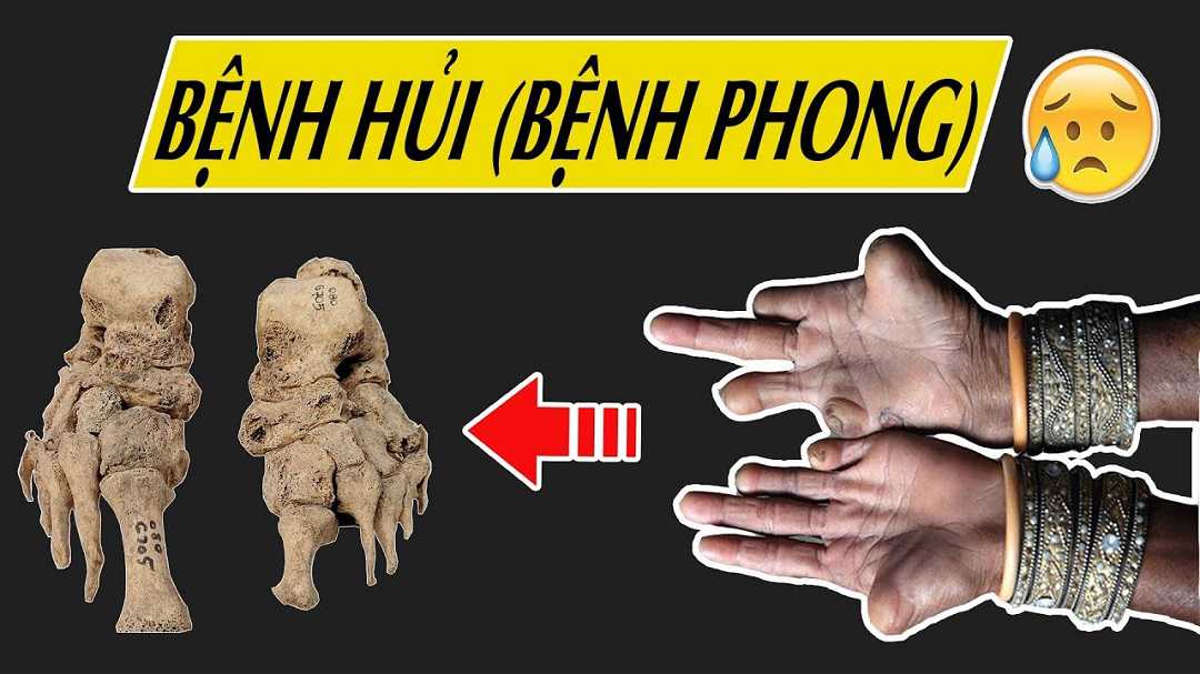 Bệnh phong có những dạng nào