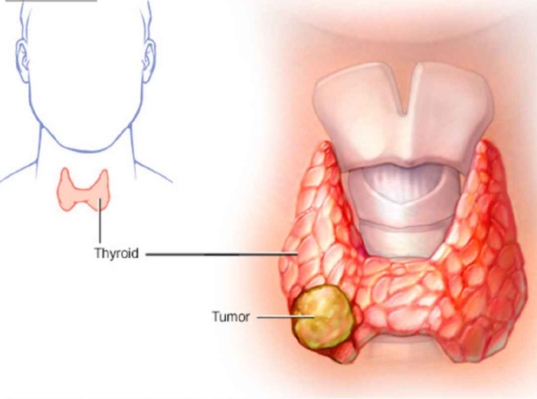 Làm thế nào để nhận biết được triệu chứng bệnh ung thư tuyến giáp dạng nhú?