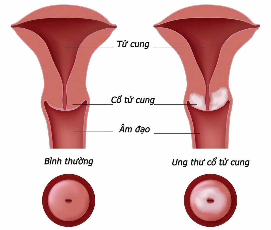 Đối tượng dễ mắc Ung thư cổ tử cung