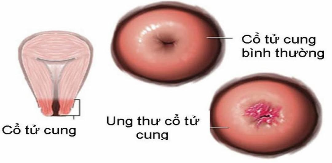 Dấu hiệu nhận biết Ung thư cổ tử cung