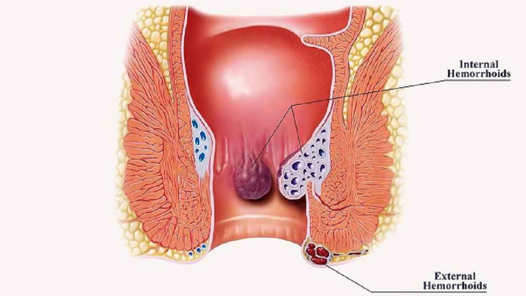 Bệnh trĩ gồm cả trĩ nội và trĩ ngoại với vị trí nằm ở trên và dưới đường lược