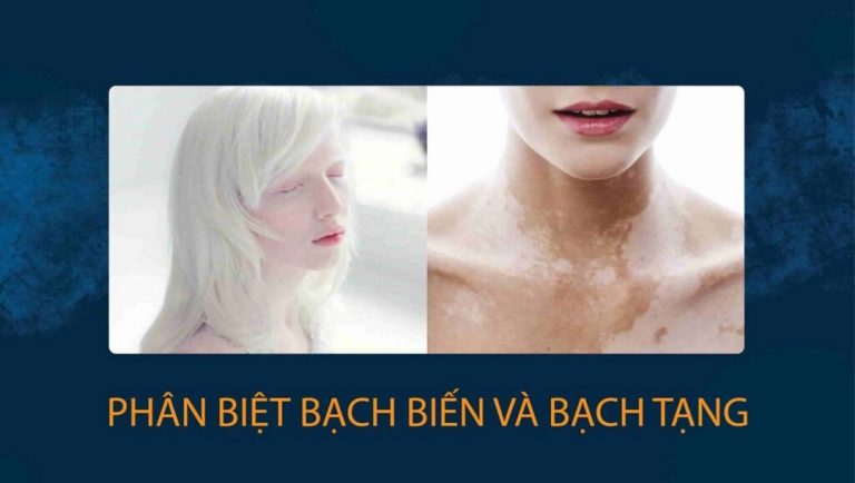 Phân biệt bệnh bạch biến và bệnh bạch tạng bằng các phương pháp công nghệ