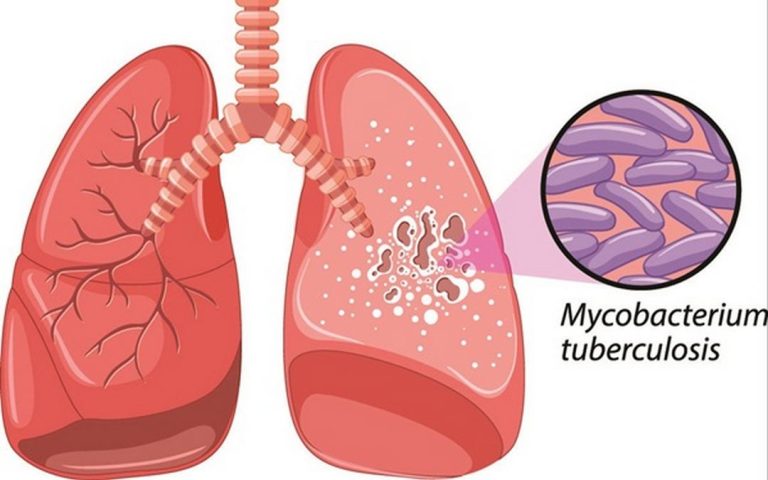 Cách phòng ngừa bệnh lao phổi