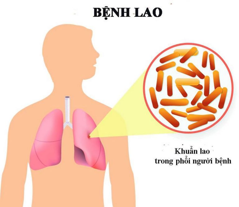 Vi khuẩn gây ra bệnh lao phổi