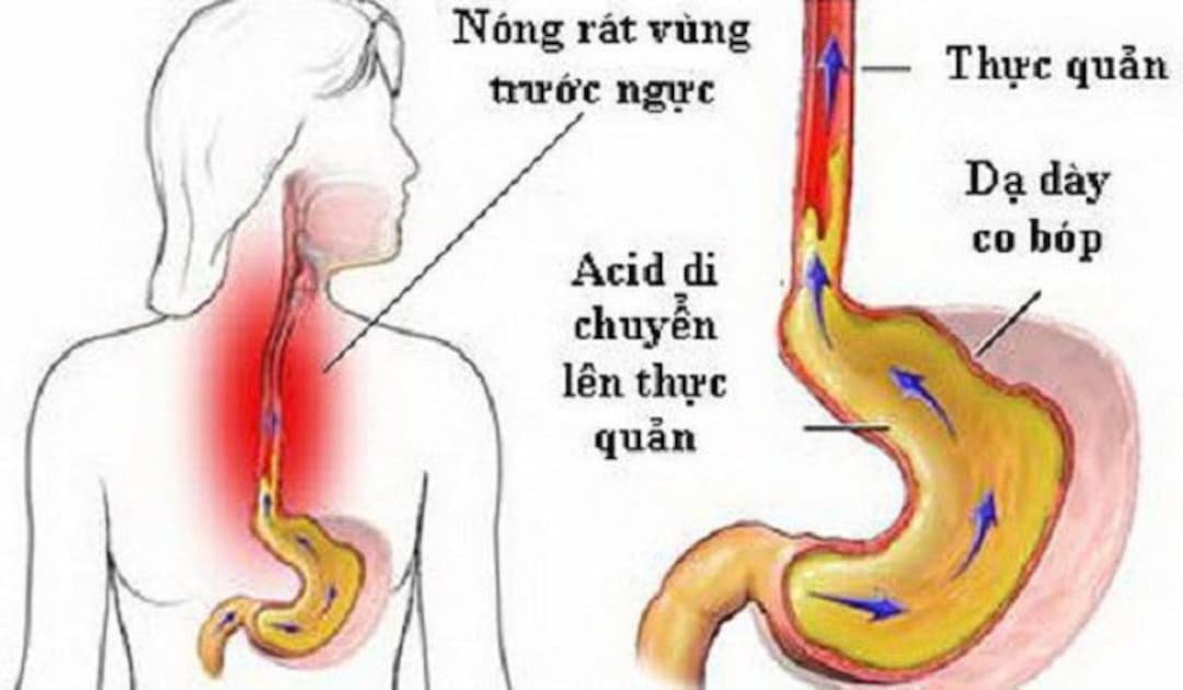 Ợ chua, ợ hơi hoặc ợ đắng