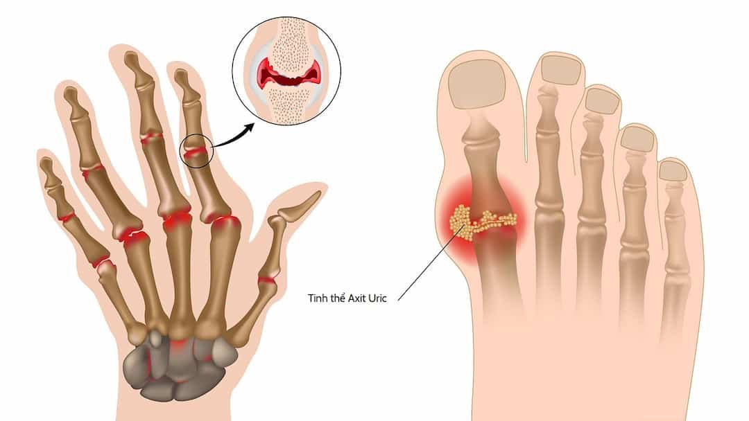 Cách phát hiện bệnh gút