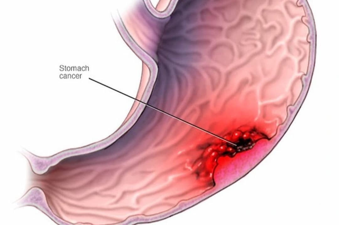 Phương thức điều trị giảm nhẹ ung thư dạ dày giai đoạn cuối