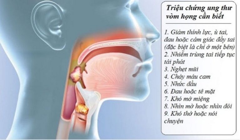 Triệu chứng của ung thư vòm họng