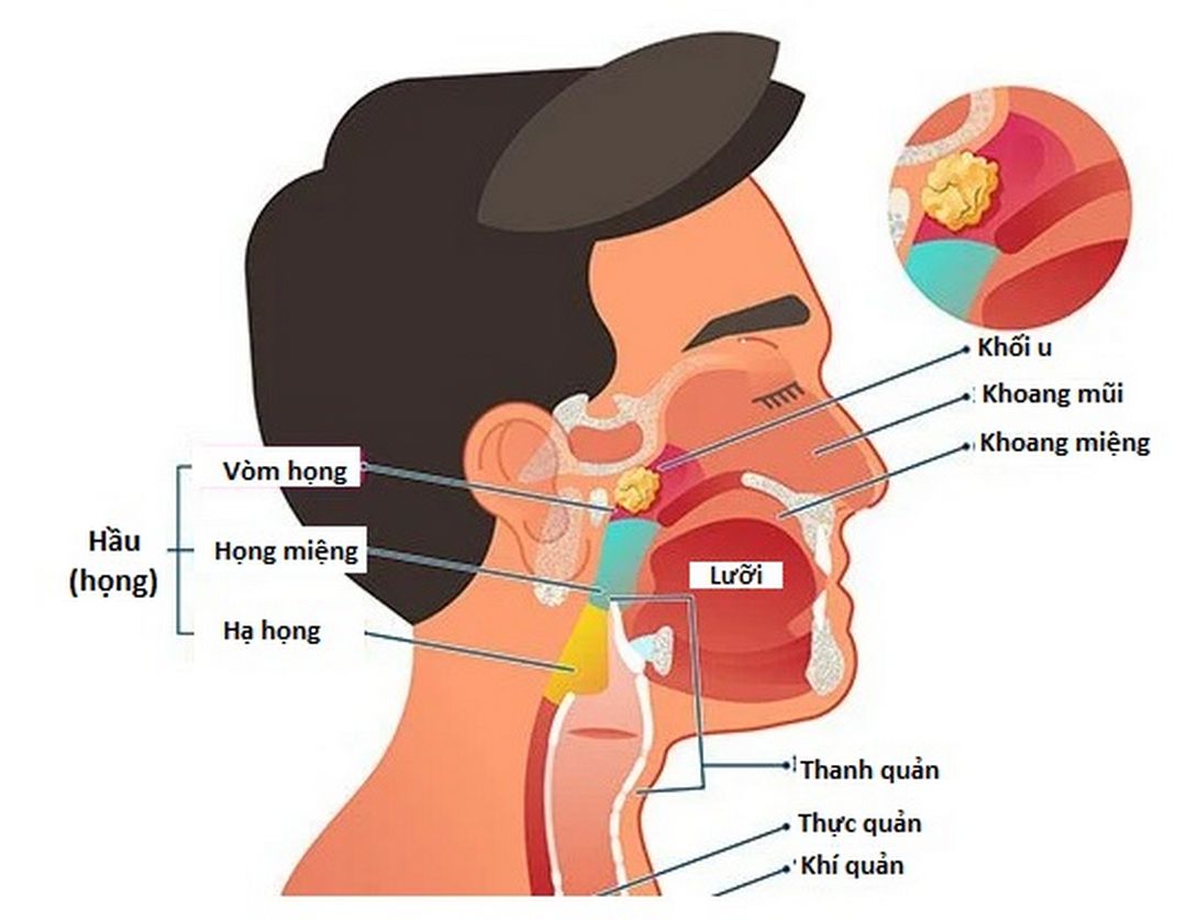 Các biện pháp để kiểm soát ung thư vòm họng