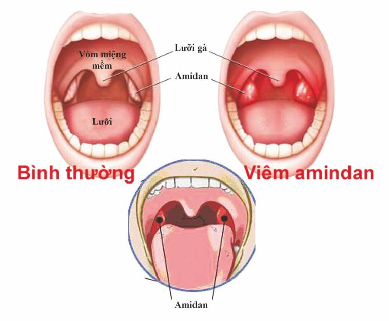 Các biện pháp phòng ngừa bệnh viêm Amidan