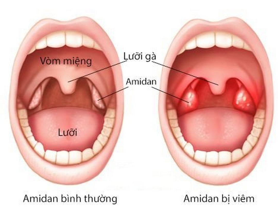 Các loại Viêm Amidan thường gặp