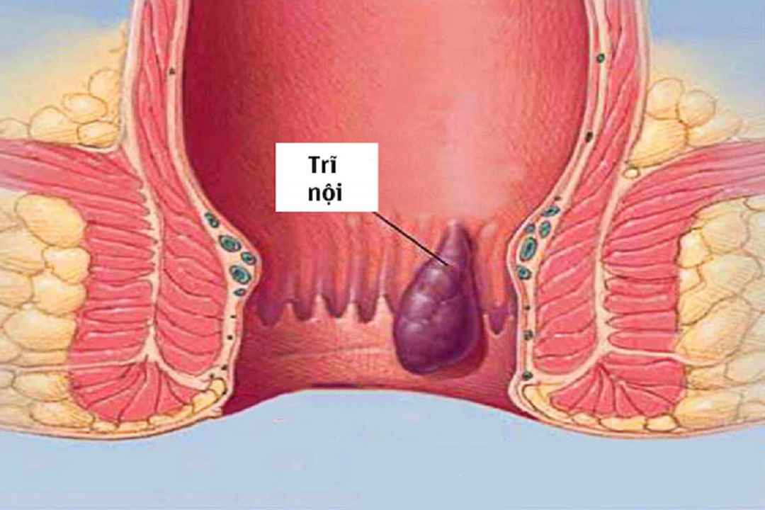 Trĩ nội