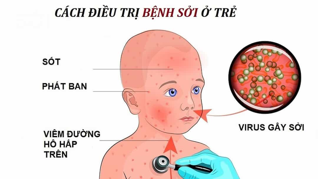 Phân loại bệnh sởi theo độ tuổi và nguyên nhân gây bệnh.