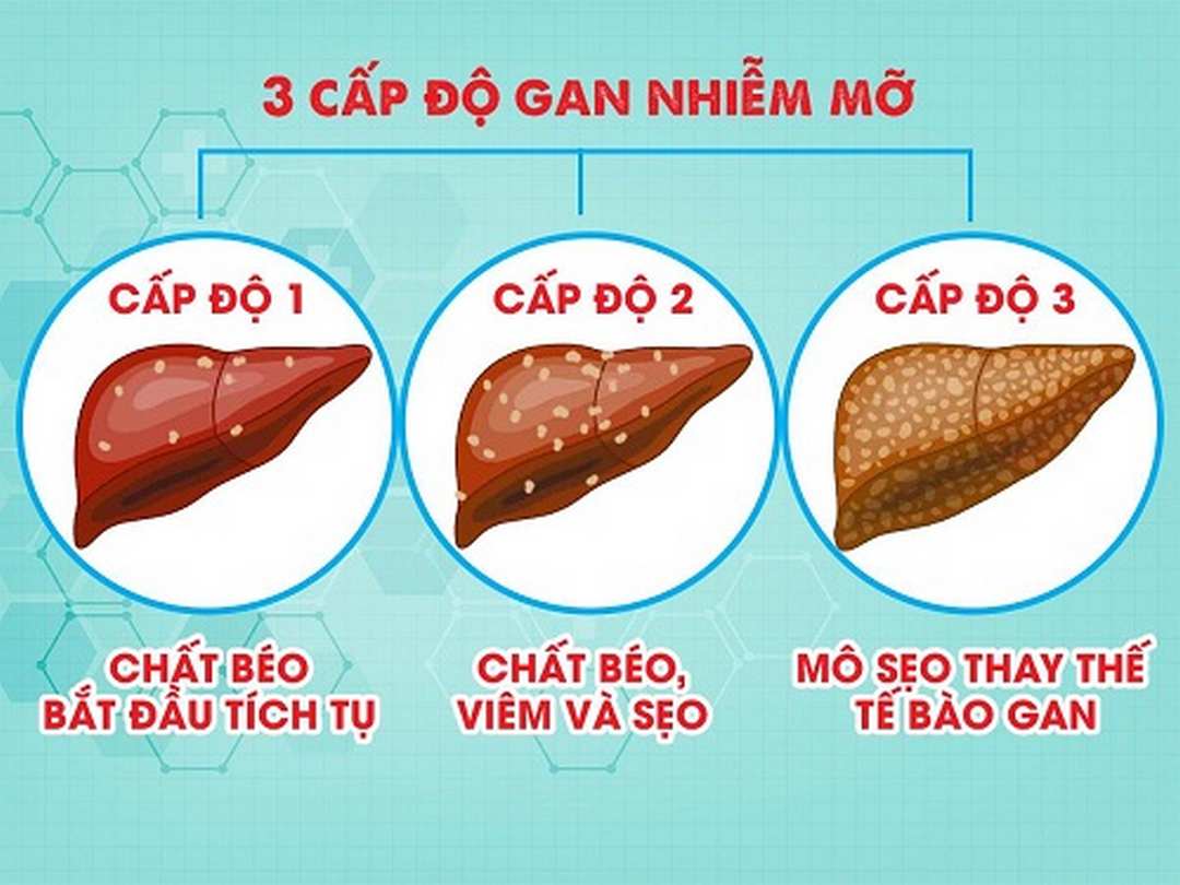 Tác động của gan nhiễm mỡ đến với sức khỏe