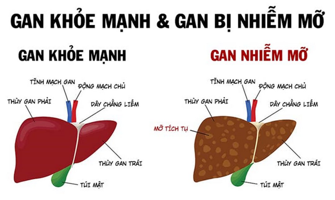 Các biện pháp điều trị gan nhiễm mỡ