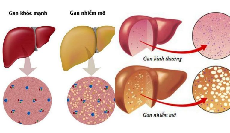 Gan nhiễm mỡ và gan bình thường